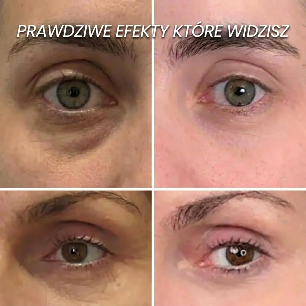 Zbliżenie na okolice oczu przed i po 30 dniach stosowania